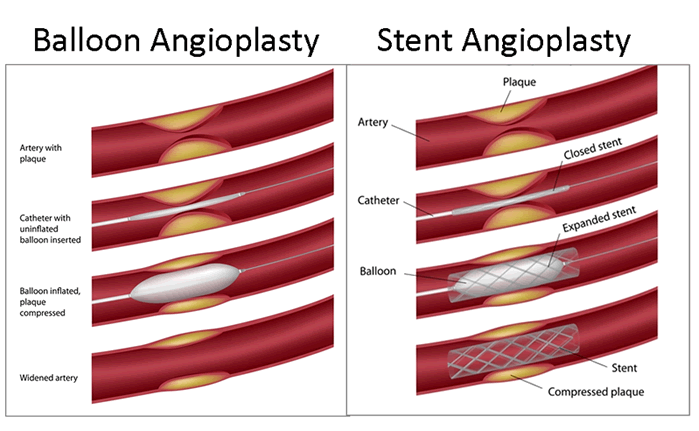 Angioplasty and stent pic