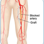 pad-bypass-procedure pic